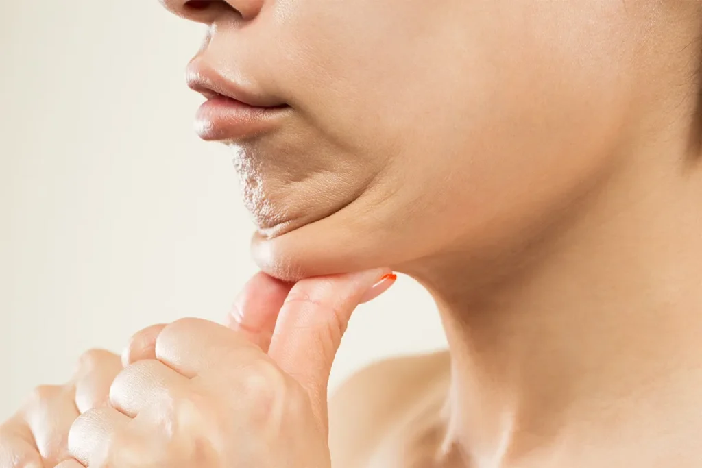 第3章 糸リフトだけでは頬こけが改善しづらいケースとは？