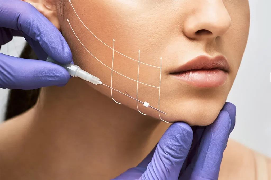 1-1. 糸でたるみを引き上げる仕組みと美肌効果