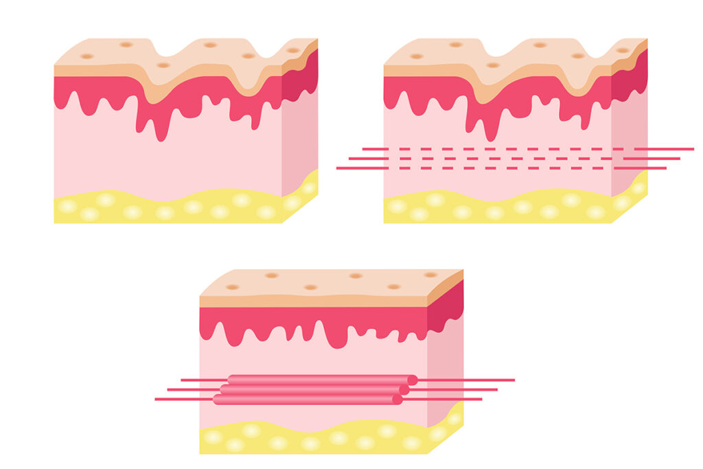 1-3. 切開リフト・ハイフ・ヒアルロン酸との違いと使い分け