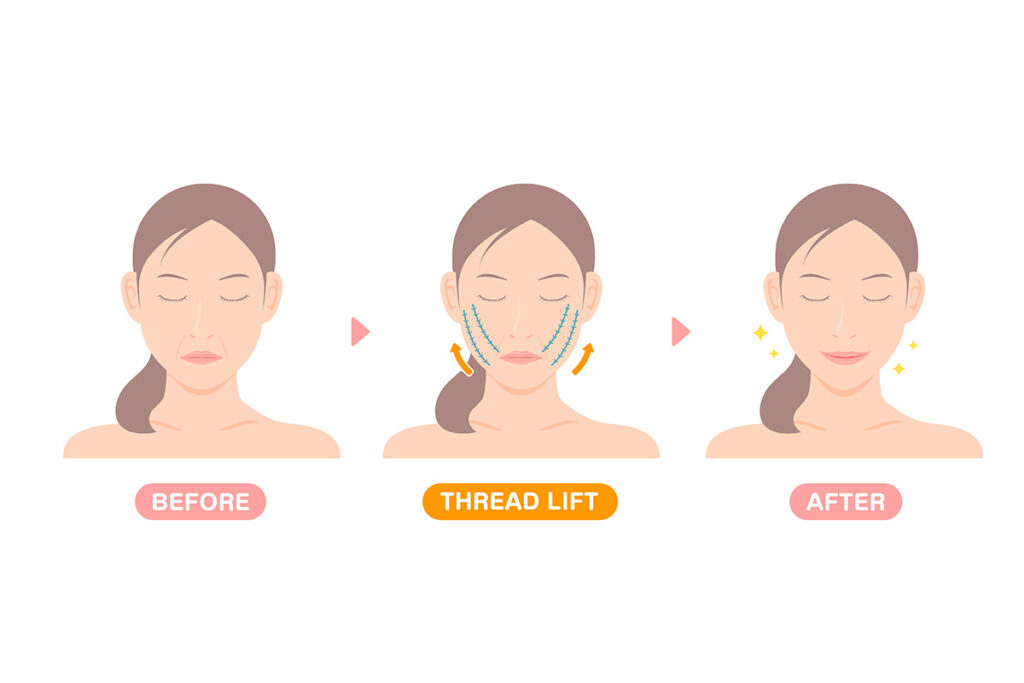 第4章. 糸リフトで得られる主な美容効果4選