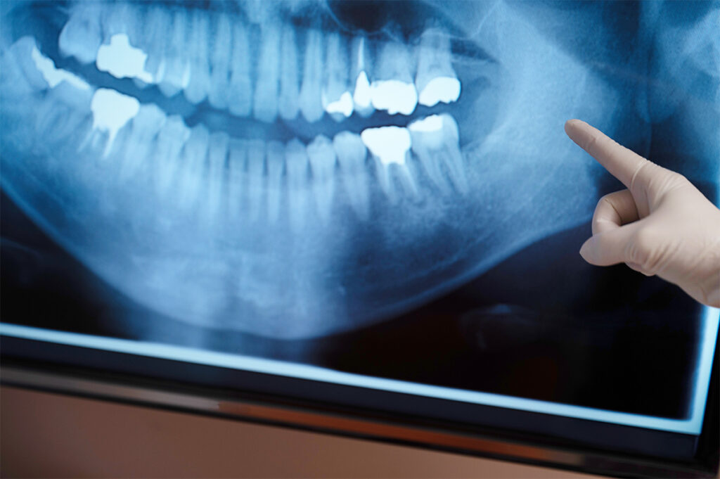 糸リフトはレントゲン・CT・MRIに写る？医療検査での安全性と申告の必要性