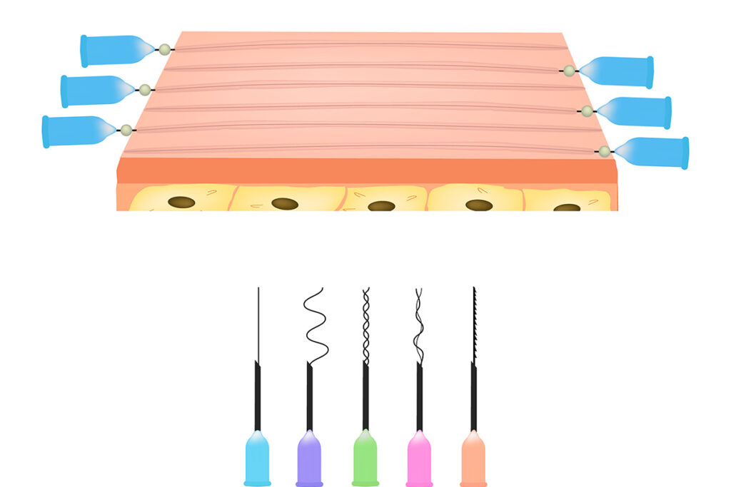 第2章 糸リフトの感染症以外のリスク